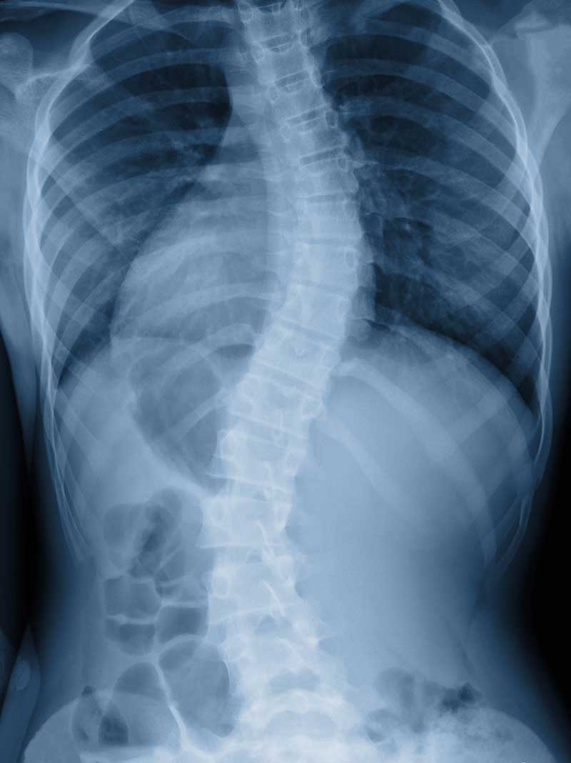 Scoliosis Amsterdam, NY